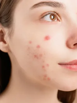 Simple Steps For How to Remove Pimples at Home in 2024