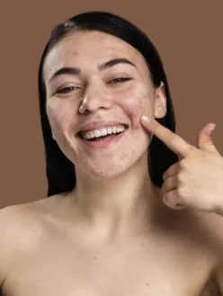 No 1 Solutions For How to Remove Pimples Naturally at Home