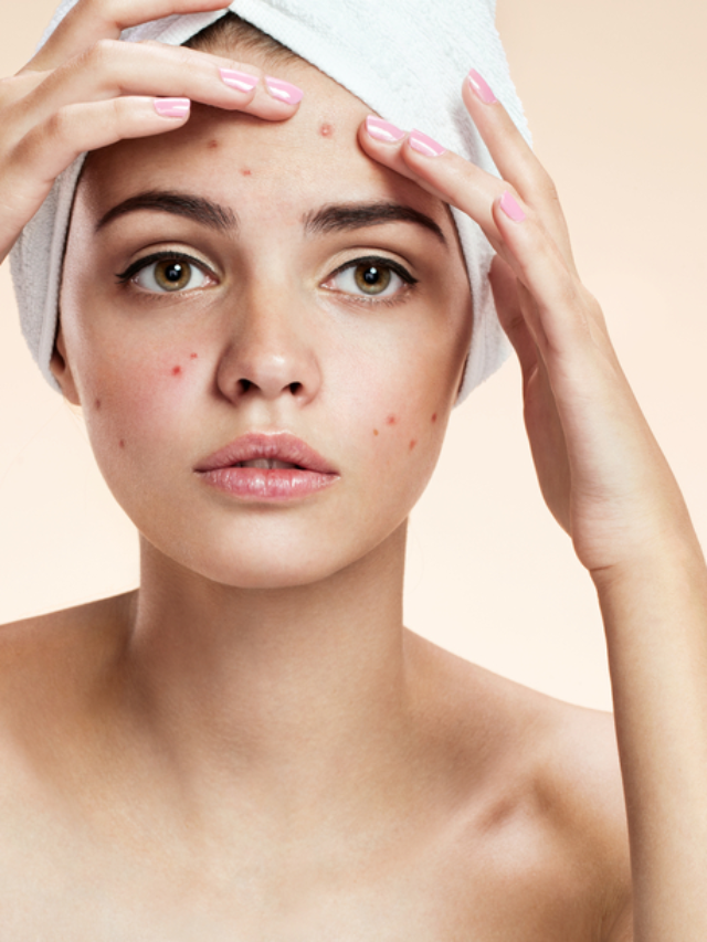 How to Remove Pimples Overnight: Effective Tips and Tricks