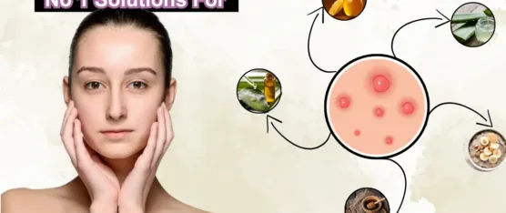 how to remove pimples naturally at home